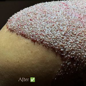 9-hair-transplant