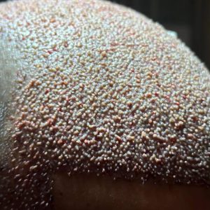 2-hair-transplant