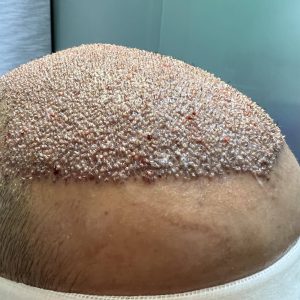 hair-transplant-1
