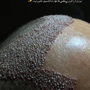 9-hair-transplant