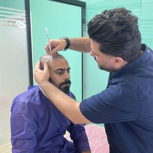 3-hair-transplant