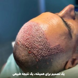 7-hair-transplant