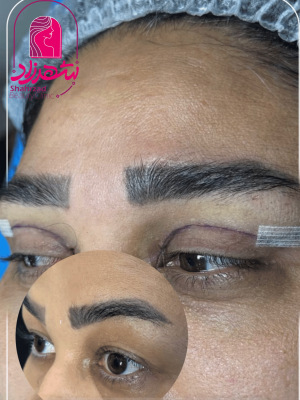 blepharoplasty10