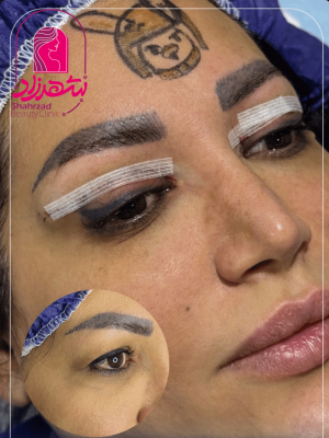 blepharoplasty11
