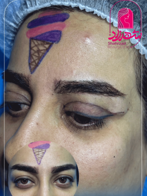 blepharoplasty12