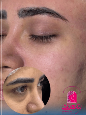 blepharoplasty13