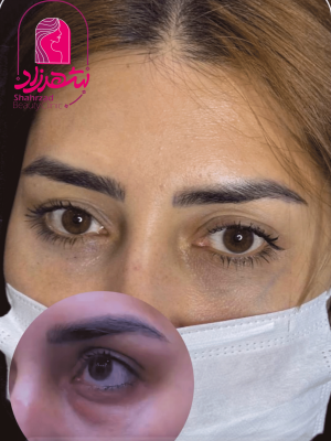 blepharoplasty14
