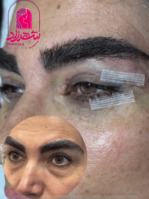 blepharoplasty15