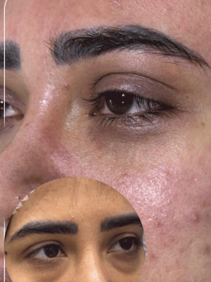 blepharoplasty16