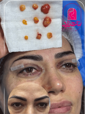 blepharoplasty18