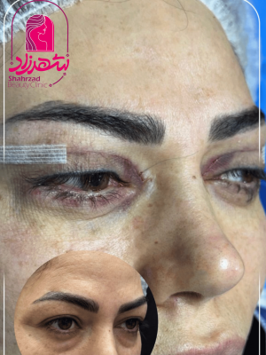 blepharoplasty19