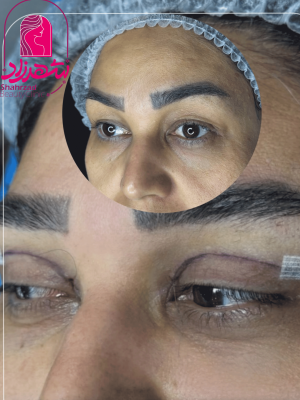 blepharoplasty5