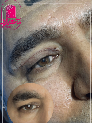 blepharoplasty6