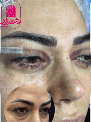 blepharoplasty7