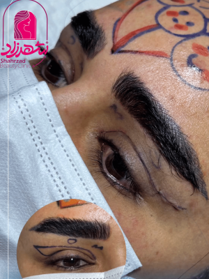 blepharoplasty8