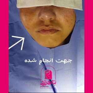 buccal-fat2