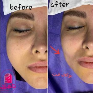 buccal-fat3