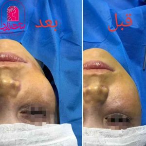 buccal-fat4