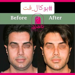 buccal-fat6