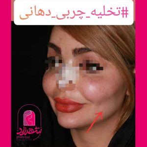 buccal-fat8