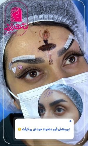 direct -brow-lift-1 Medium