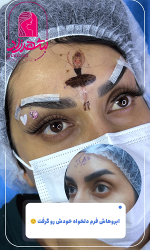 direct--brow-lift-1