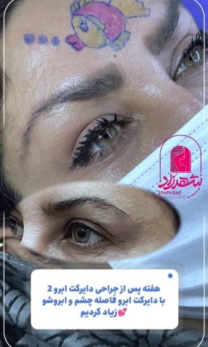 direct--brow-lift-11 Medium