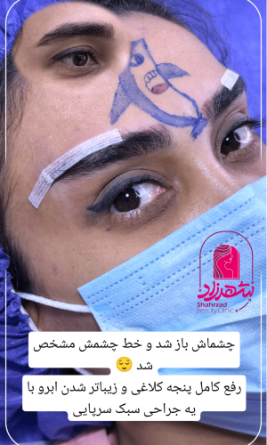 direct--brow-lift-13