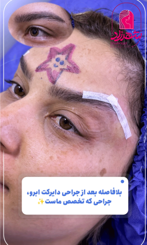 direct--brow-lift-14