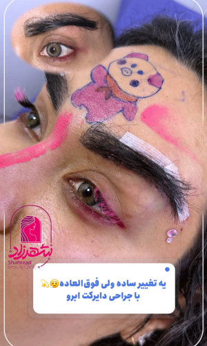 direct--brow-lift-15