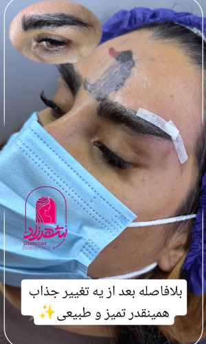 direct--brow-lift-16