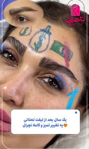 direct--brow-lift-17