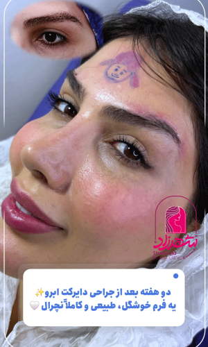 direct--brow-lift-18