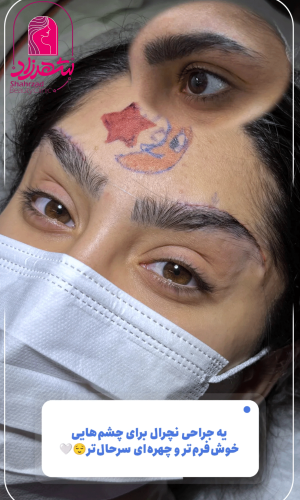 direct--brow-lift-19