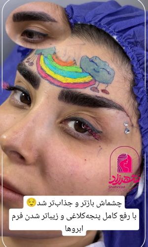 direct--brow-lift-22
