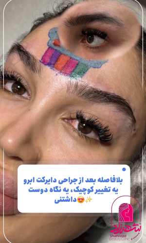 direct--brow-lift-23