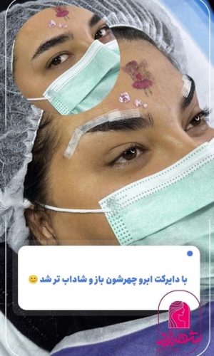 direct--brow-lift-3 Medium