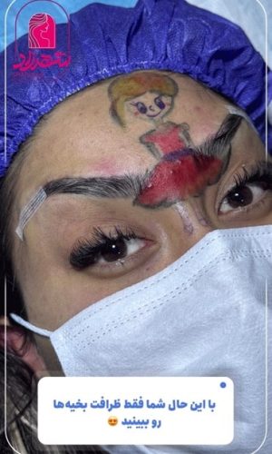 direct--brow-lift-4 Medium