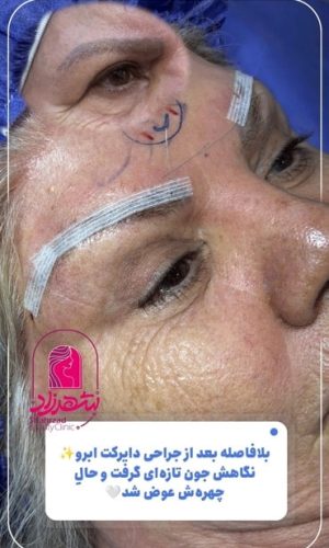 direct--brow-lift-5 Medium