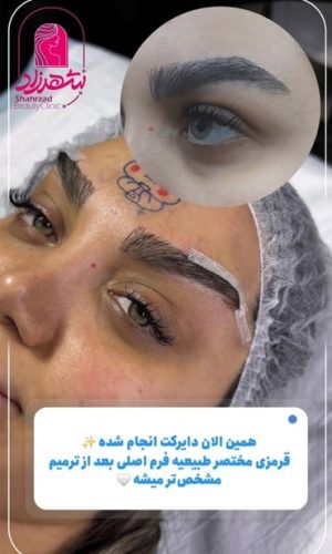 direct--brow-lift-6 Medium