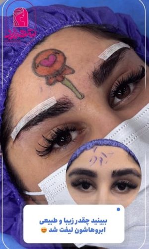 direct--brow-lift-7 Medium
