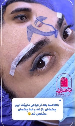 direct--brow-lift-9 Medium