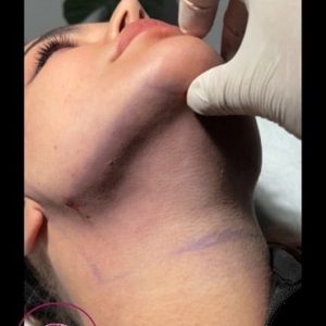 face-slimming1 Medium