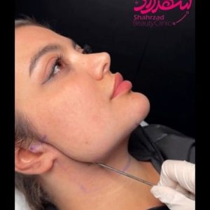 face-slimming4 Medium