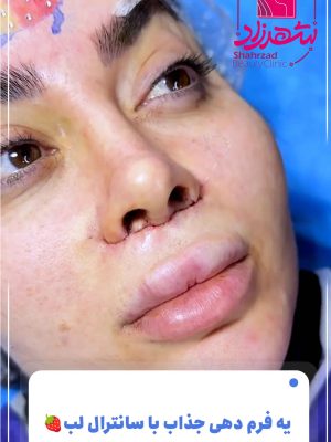 lip-lift1