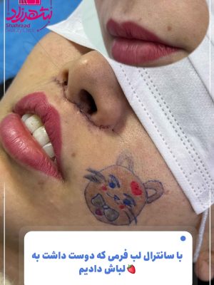 lip-lift2