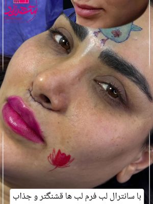 lip-lift3