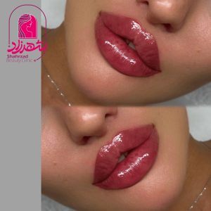 lipfiller10