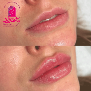 lipfiller11