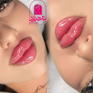 lipfiller12